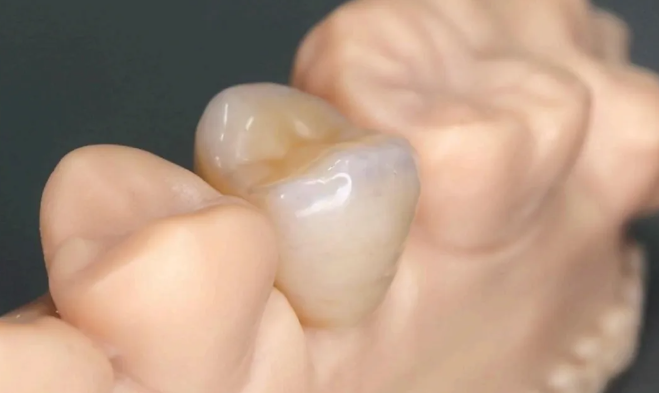 使用Formlabs形朗Permanent Crown Resin打印的牙冠 使用Formlabs形朗Permanent Crown Resin打印的牙冠